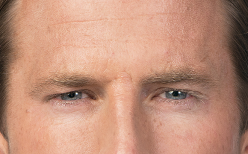 Botox Before and After Picture Botox Before and After Picture